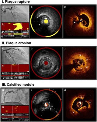 Combined Use of Multiple Intravascular Imaging Techniques in Acute Coronary Syndrome